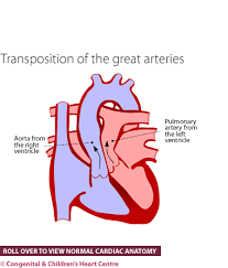 The main pulmonary artery splits into the right and left pulmonary arteries, which we will better see in later images. Transposition Of The Great Arteries Congenital Children S Heart Centre