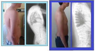 A 20 year old male with scheuermann's disease, showing various measurement of kyphotic/lordotic degrees and their. Scheuermann S Kyphosis Orthopaedia