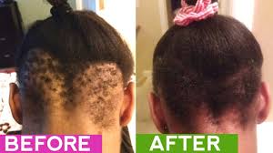 How To Regrow Hair Naturally Alopecia Bald Spots Thick Hair Remedies Help Hair Loss Regrow Hair Naturally