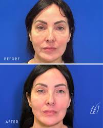 TUMMY TUCK BEFORE + AFTER