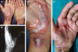 Image result for Dermatomyositis