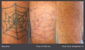 Advanced laser tattoo removal system. Laser Tattoo Removal Treatment Lumos Dermatology
