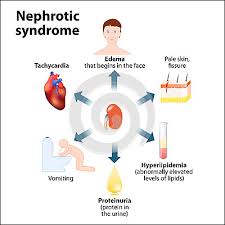 ayurvedic treatment of nephrotic syndrome