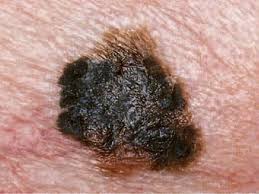 A tan will offer limited protection from sunburn, but usually no more than spf3. Is It Skin Cancer Cbs News