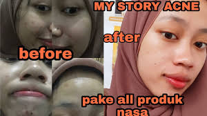 Produk asal korea ini dipercaya baik digunakan untuk menghilangkan bekas jerawat. My Story Acne Cara Ampuh Hilangkan Bekas Jerawat Pakai Produk Nasa Youtube