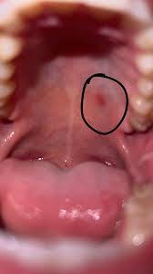 Image result for Physical injury red spots roof of mouth