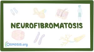 Tumors, or neurofibromas, grow along the body's nerves or on or underneath the skin. Neurofibromatosis Video Explanation Osmosis