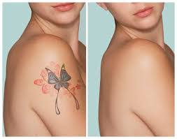 Using the search function before posting any questions. Services Laser Tattoo Removal From Mandi Himachal Pradesh India By Neelkanth Hospital Mandi Id 5467632