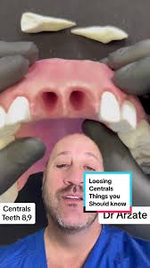 it's crucial to understand the importance of central teeth in the upper  maxilla and how their loss can significantly affect bone structure and  facial aesthetics in a patient. Central teeth not only ...