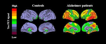 Causes, stages, and treatments are provided. New Method Enables Accurate Diagnosis Of Alzheimer S Disease