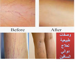النتيجة المنتظرة من علاج الخراج. Ø¹Ù„Ø§Ø¬ Ø§Ù„Ø¯ÙˆØ§Ù„ÙŠ Ø¨Ø§Ù„Ø§Ø¹Ø´Ø§Ø¨