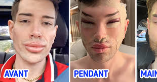 Un homme montre les résultats de sa chirurgie des yeux et du retrait de  comblements, la toile en est impressionnée
