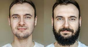 Epstein js, bared a, kuka g. How To Do Beard Transplantation Hair Transplant In Turkey