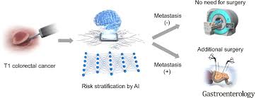 Rate of spread is unpredictable at present and likely depends on growth factors, cancer differentiation, and unknown factors. Artificial Intelligence System To Determine Risk Of T1 Colorectal Cancer Metastasis To Lymph Node Gastroenterology