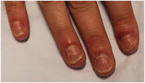 Image result for Nail Pitting