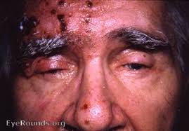 Image result for herpes zoster