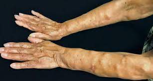 Scielo Brazil Dercum S Disease A Rare And Underdiagnosed Disease Dercum S Disease A Rare And Underdiagnosed Disease