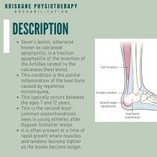 Image result for Calcaneal Apophysitis