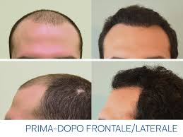 Più di 20 anni di esperienza nel trapianto capelli a torino · dr. Trapianto Capelli Smart Fue L Autotrapianto Con Massimo Risultato