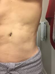 I am not over wei. How Do I Get Rid Of Ripples Wrinkles On My Stomach From Abdominal Lipo Photo