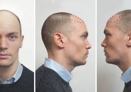 Ma la caduta dei capelli in giovane età può avere anche per altre cause. La Storia Di Filippo Il Modello Che Ha Scelto L Autotrapianto Capelli