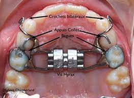 Malabe Occh 27062011 Hyrax As Facemask Orthodontist Chamberland Quebec Dental Braces Orthodontics Dental Implants