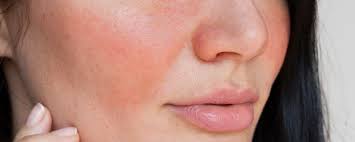 Traitement Contre La Rosacee A Prix Abordable Dermapure