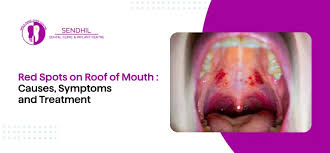 Image result for Mouth ulcers symptoms roof of the mouth