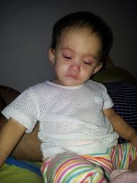 It causes a high fever and then a how is roseola diagnosed in a child? Familie Mohamadhafidh