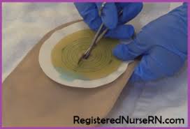 A pouch sticks to the skin around the stoma to collect stool. How To Change An Ostomy Bag For Nurses