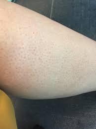 Red dots on the hands can be due to urticaria which is an allergic reaction to anything used or applied on the hands. Does Anyone Know The Best Way To Get Rid Of The Red Marks On My Legs Skincareaddicts