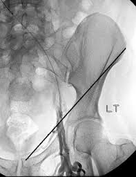 Choose from 52 different sets of flashcards about inguinal+ligament on quizlet. Venous Stenting Across The Inguinal Ligament Journal Of Vascular Surgery