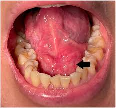 Image result for Sialolithiasis