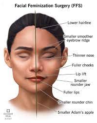 Facial Feminization Surgery (FFS): Procedure & Recovery