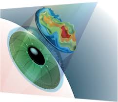 I Lasik Gunumuzun En Yenilikci Lazer Teknolojisi Intralase Ve Ileri Kisiye Ozel Tedavinin Kombinasyonudur I Lasik Tamamen Kisiye Ozledir Tum Surec Tintin