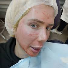 Discover short videos related to oli london before and after on tiktok. Bts Superfan Oli London Has Skin Whitening Injection To Look More Korean Daily Star