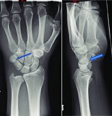 Image result for Pisiform Bone