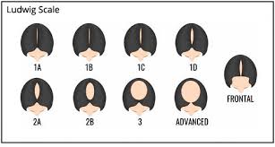 Understanding Hair Loss In Men Women Pai Hair Clinic