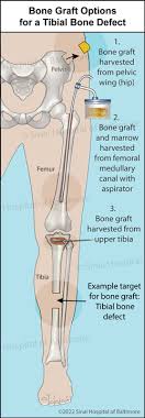 نتیجه جستجوی لغت [graft] در گوگل