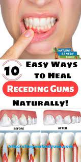 10 Easy Ways To Heal Receding Gums Naturally Gum Recession Can Cause Pockets Or Gaps To Form Between The Teeth Receding Gums Natural Remedies Natural Therapy