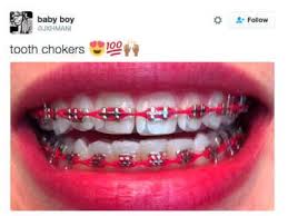 17 Jokes About Chokers That Have Gone Way Too Far Braces Bands Cute Braces Colors Cute Braces