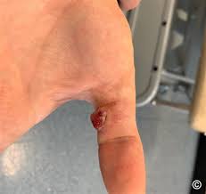 Image result for Pyogenic Granuloma