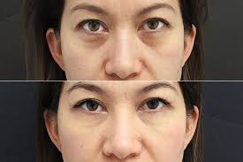 Baking soda not only cleans your house, but it also improves your skin. How To Get Rid Of Eye Bags Without The Need For Surgery Mirror Online