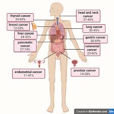 Image result for Cachexia in Cancer
