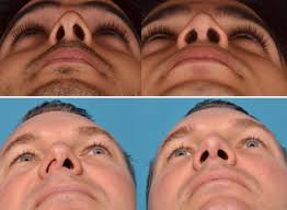 Let's face it, parents, contact sports like football, soccer, boxing, wrestling and hockey increase the risk of injuries. Is Your Nose Bent Out Of Shape Maybe It S A Deviated Nasal Septum Pacific Neuroscience Institute