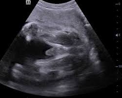 Saat anda berusaha belajar membaca hasil usg, terkadang agak sulit bagi dokter untuk ini tergantung dari kejelasan gambar dan kemampuan dokter dalam menafsirkan hasil usg. 58 Gambar Usg 2 Dimensi Bayi Perempuan Gokil