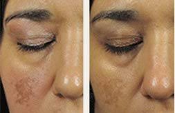 Not only can it improve the look and feel of the skin, but it can also work wonders on. Microneedling Your Complete Guide To The Skin Treatment Everyone Is Talking About Beauty Editorialist