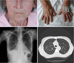 Figure 15 11 From Interstitial Lung Disease Definition Of Pulmonary Manifestations And Complications Of Scleroderma Semantic Scholar