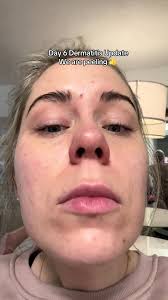 Chemical Peels for Dermititis