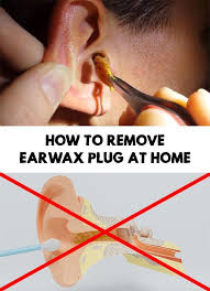 How To Remove Earwax Plug At Home Cleaning Your Ears Clean Ear Wax Out Ear Wax